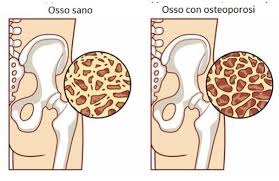 osteoporosi1.jpg